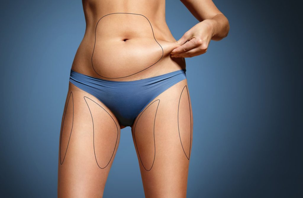 Woman pinching her stomach fat with lines drawn around target fat areas for coolsculpting