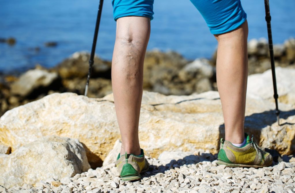 Young woman hiking outside with varicose veins on her leg