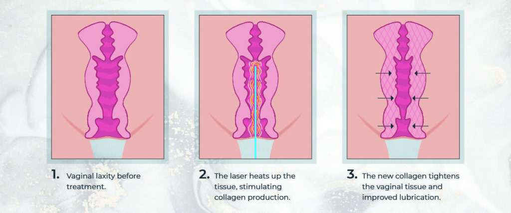 Diagram showing how laser treatment for vaginal tightness works