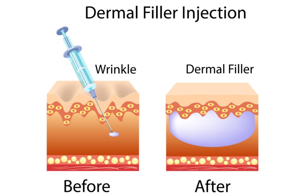 Illustration of before and after of dermal filler injection