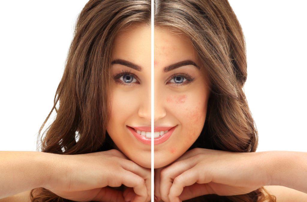 Before and after results of young woman who underwent laser scar removal for acne on her face.