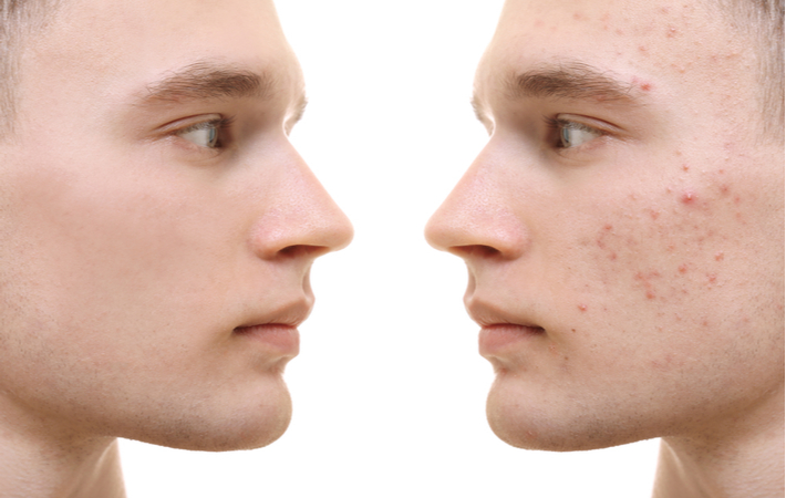 Before and after of young boy skin resurfacing to help with acne scars