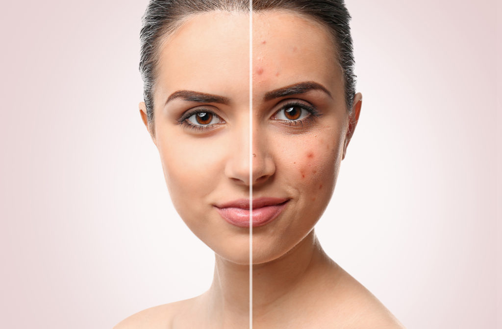 Women portrait of before and after of acne laser treatment