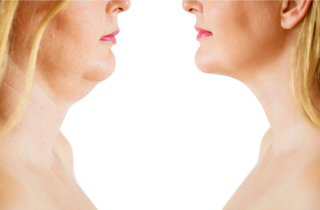 Women with double chin on left and after results with CoolSculpting to get rid of her double chin on the right