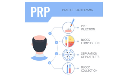 A diagram showing the four steps of PRP treatment.