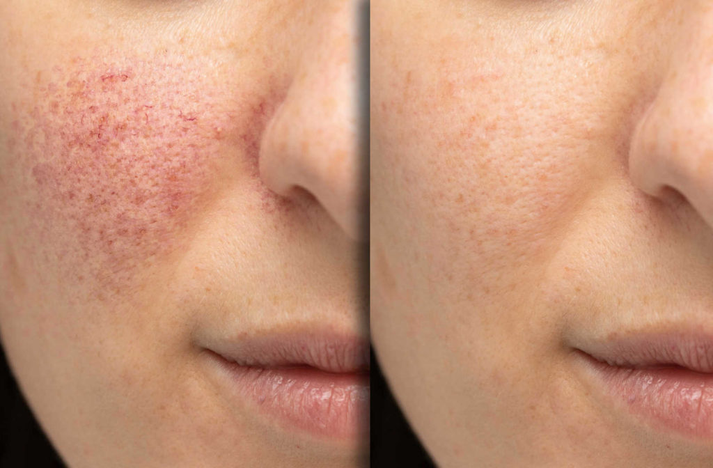 Before and after of laser treatment on facial acne.