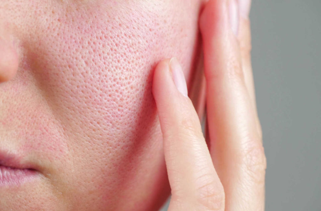 Up close image of large visible pores on a person's left cheek.