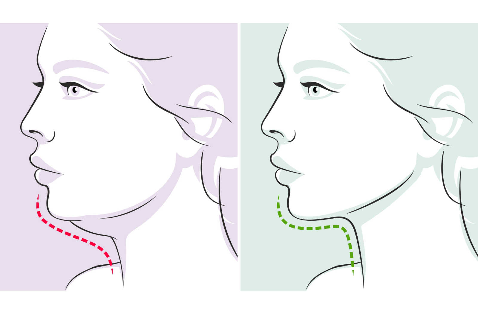 Graphical representation of a before and after of Belkyra double chin reduction.