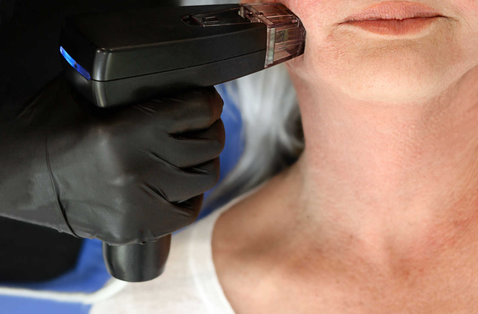 A woman receiving MORPHEUS8 treatment on her lower right cheek area.