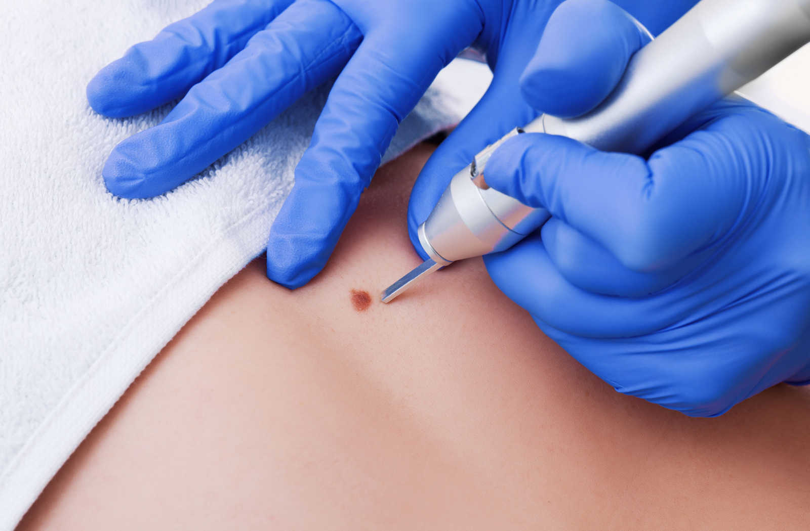 A hand of a dermatologist is cauterizing an unwanted mole on the patient's back.
