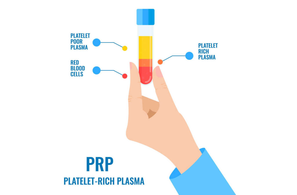 Vector image of a hand holding a test tube after centrifuge with platelet poor plasma, platelet rich plasma, and red blood cells. 