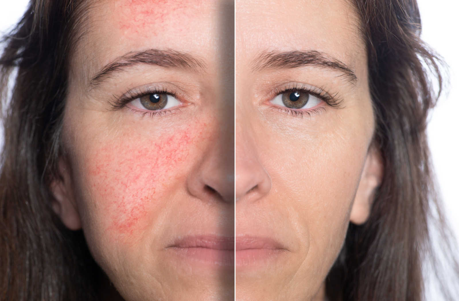 Side by side before and after of laser treatment for rosacea.