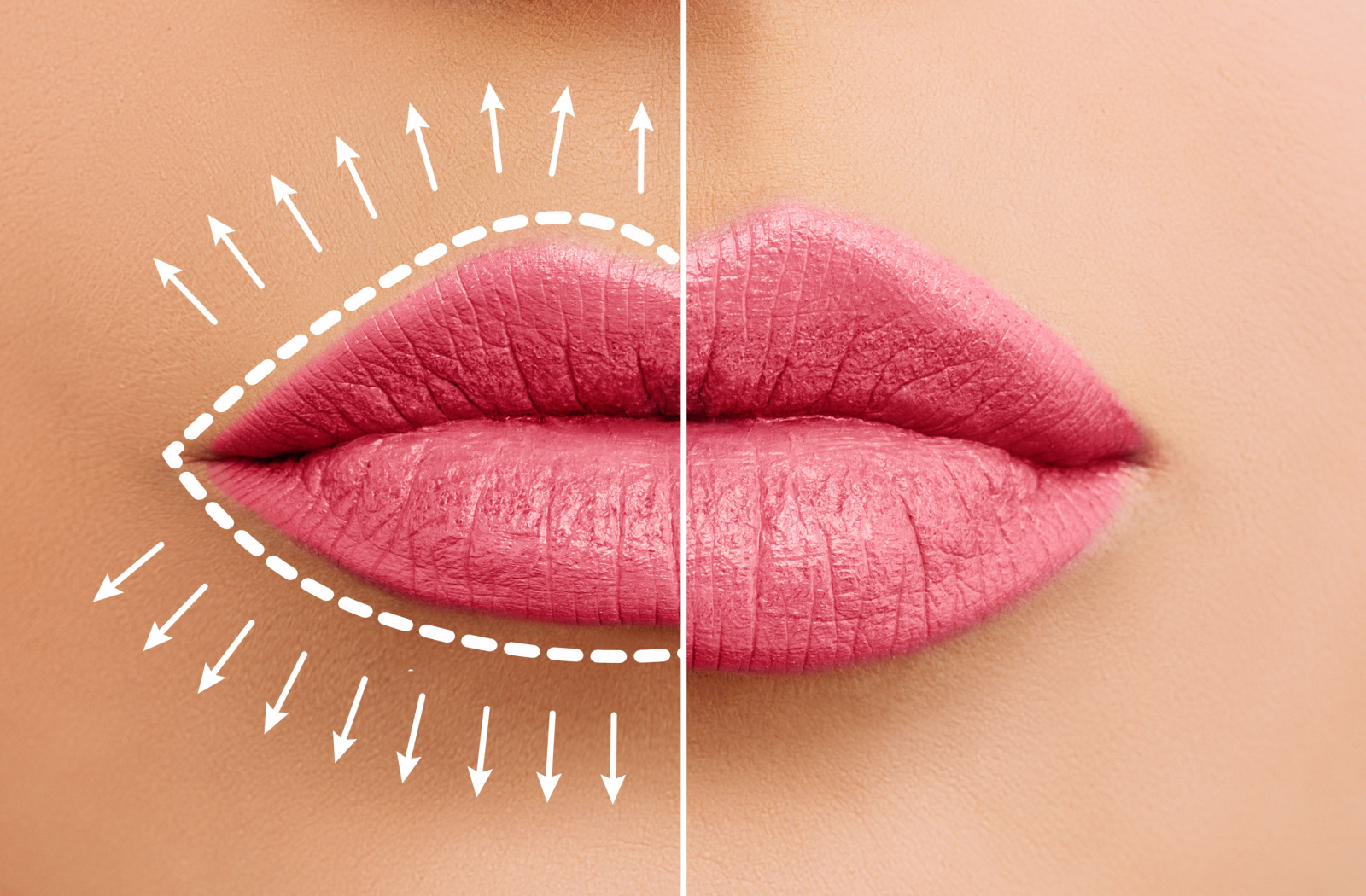 Side by side comparison of a pair of lips before and after lip injection.