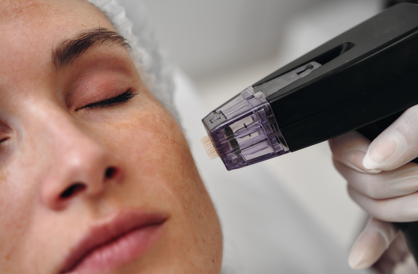 Close-up of a microneedling instrument next to a patient's face.