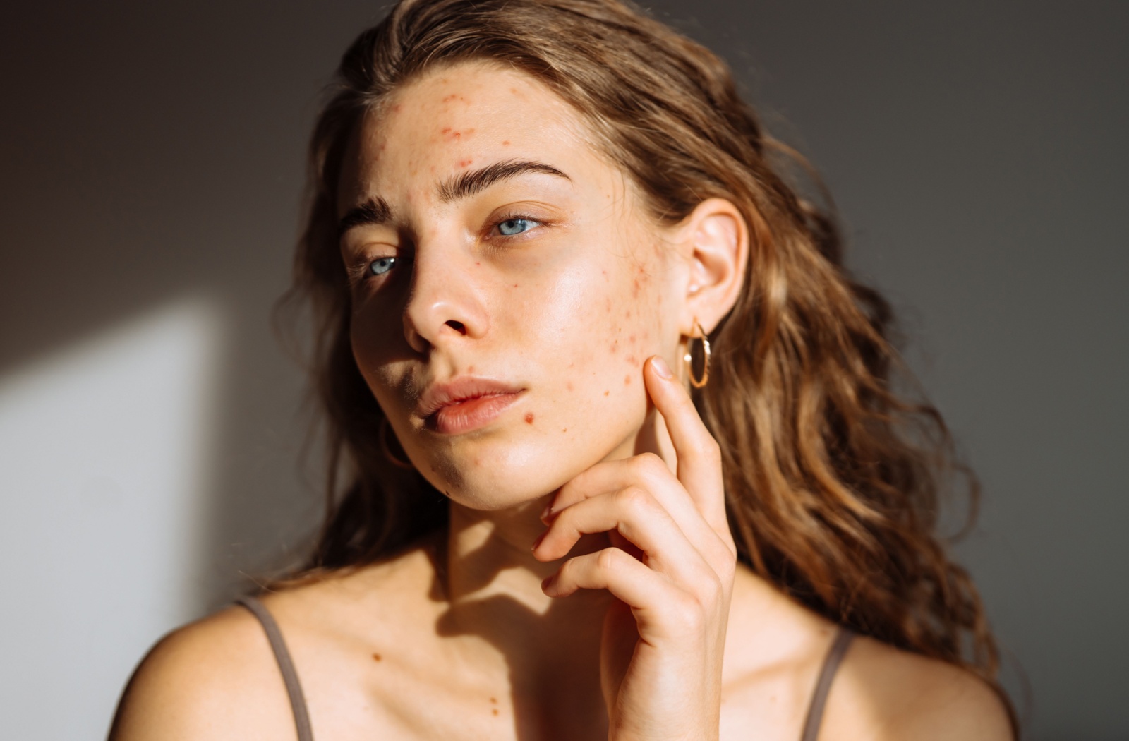 A beautiful young woman with acne scars gracefully sitting in the sunlight.
