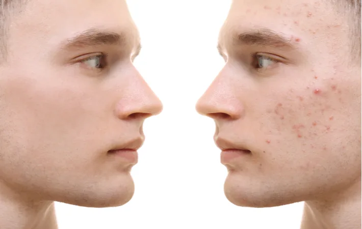 Before and after of young boy skin resurfacing to help with acne scars