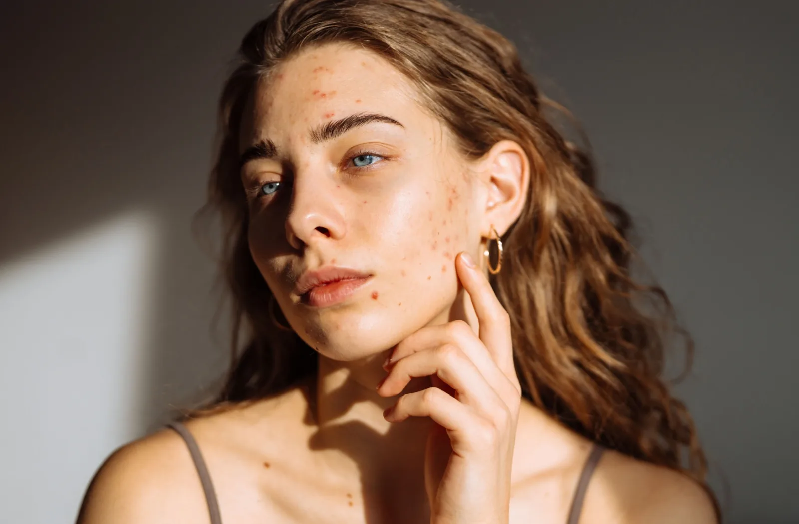 Young girl with acne visiting Zulu for skin improvement